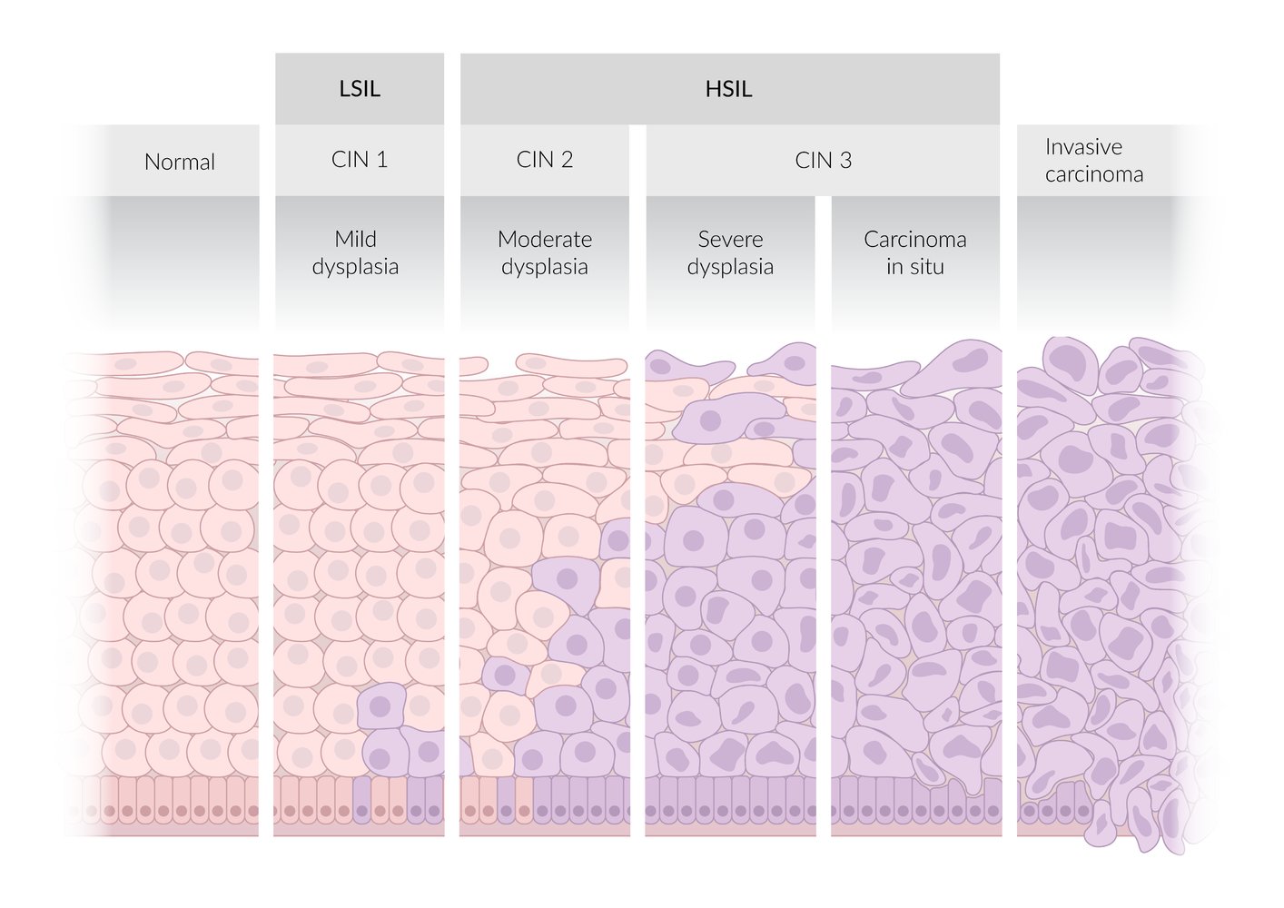 Histopathological grades of cervical cancer
