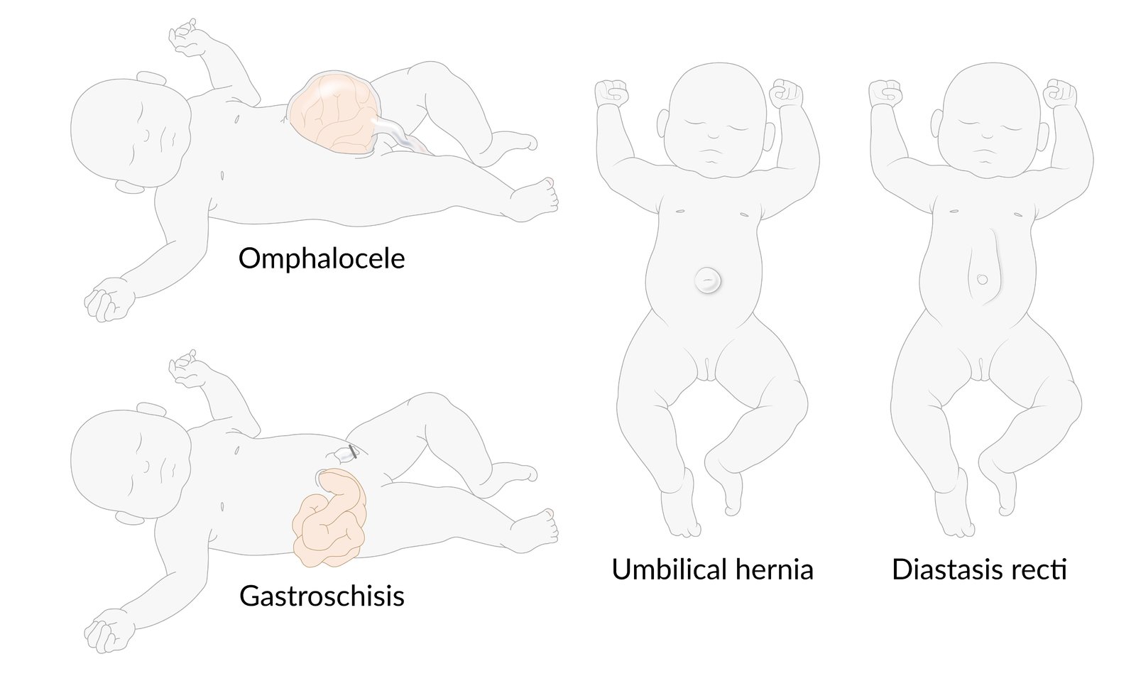 Congenital malformations of the anterior abdominal wall