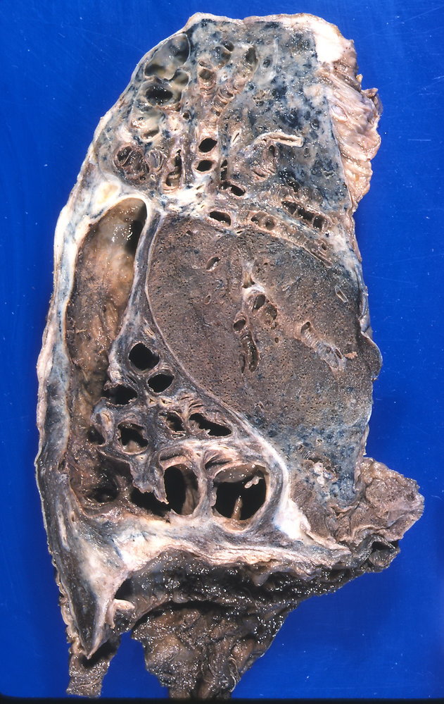 Bronchiectasis