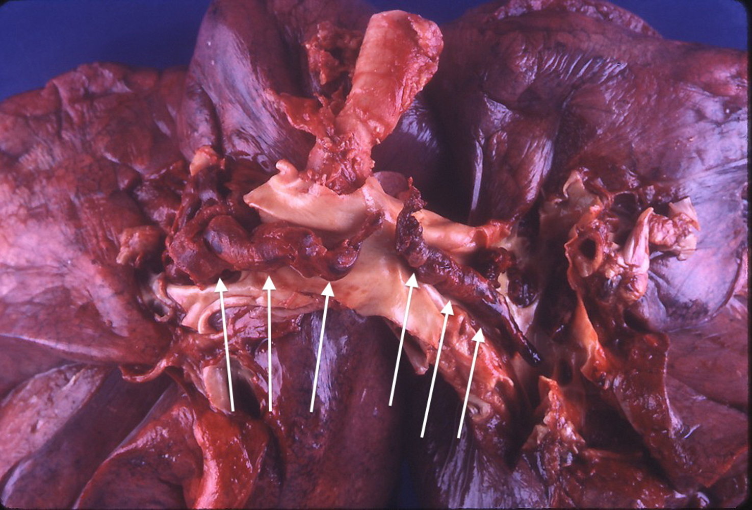 Pulmonary saddle thromboembolus