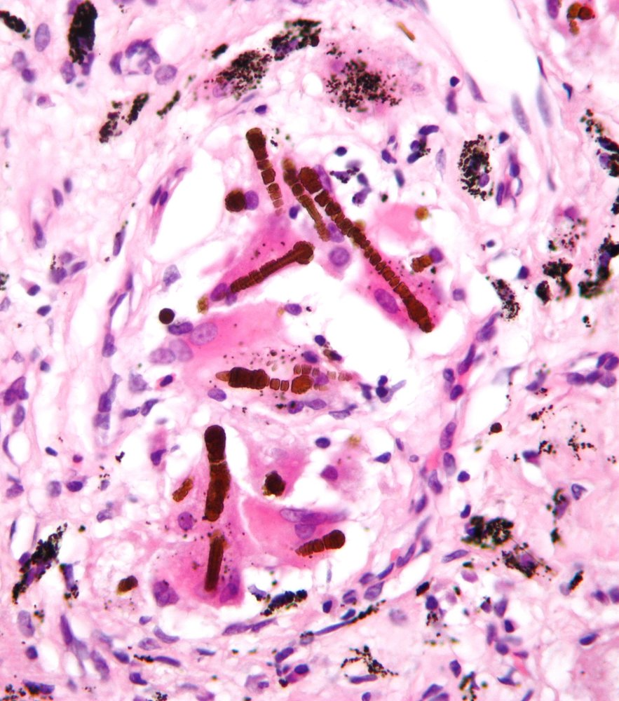Pulmonary asbestosis