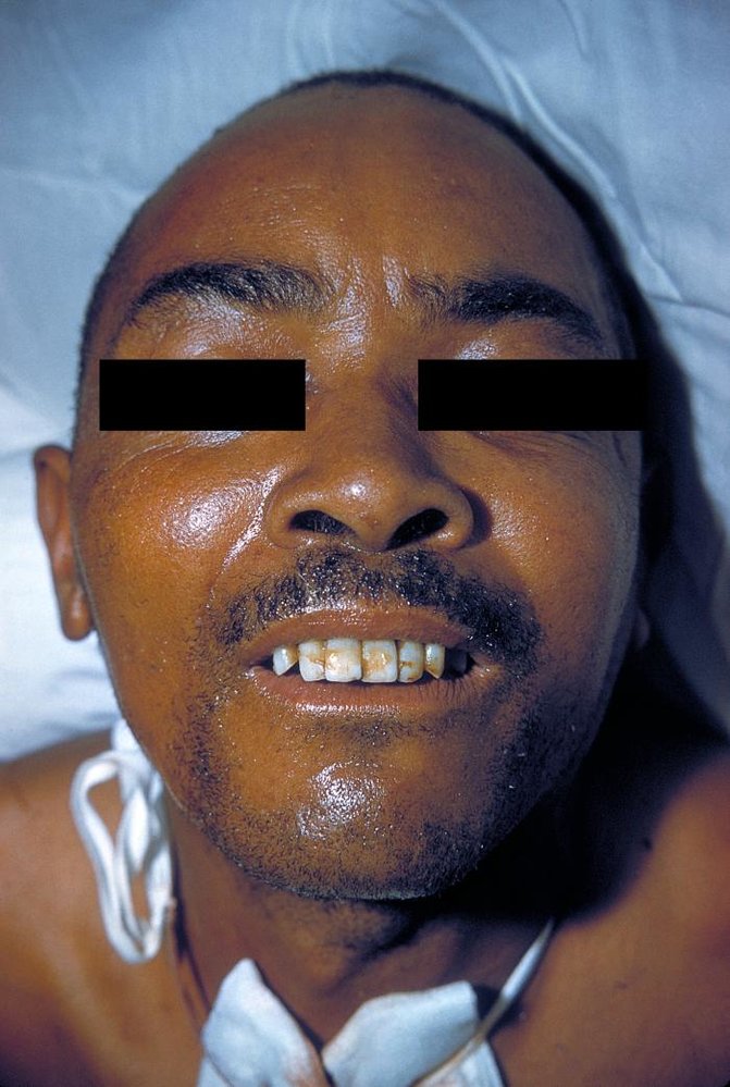Risus sardonicus in tetanus