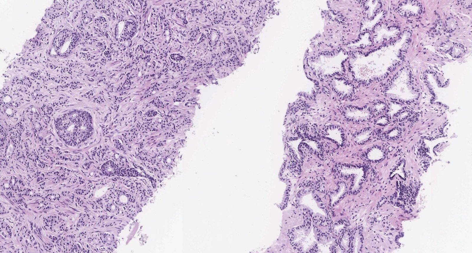 Prostate cancer