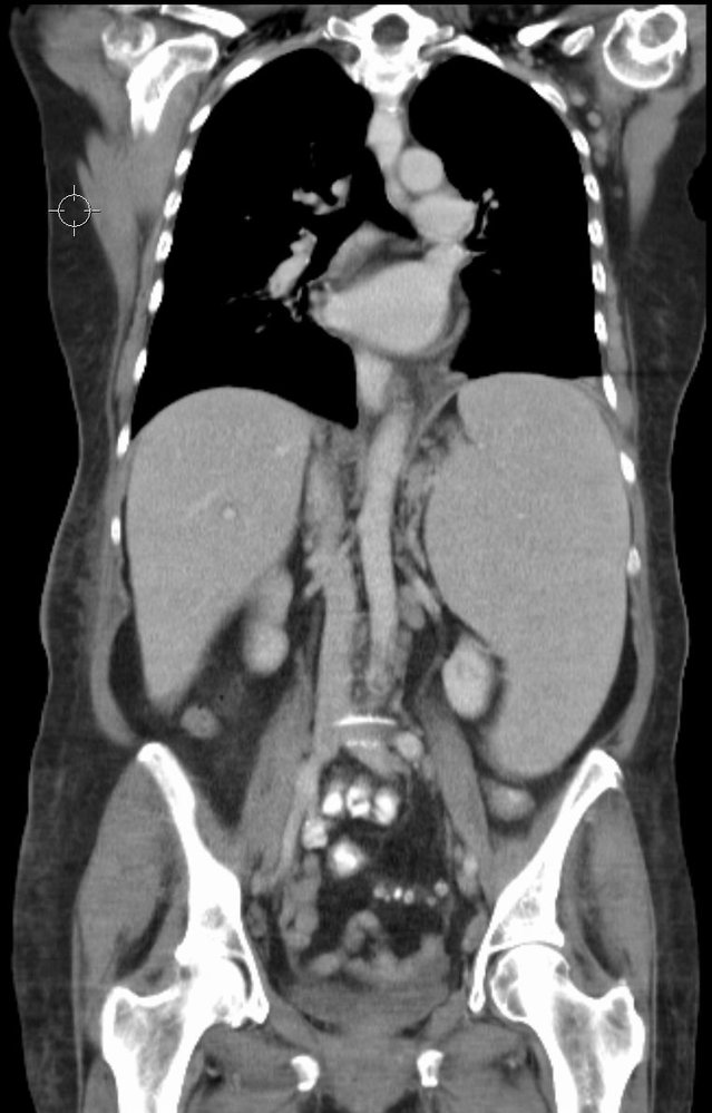 Massive splenomegaly