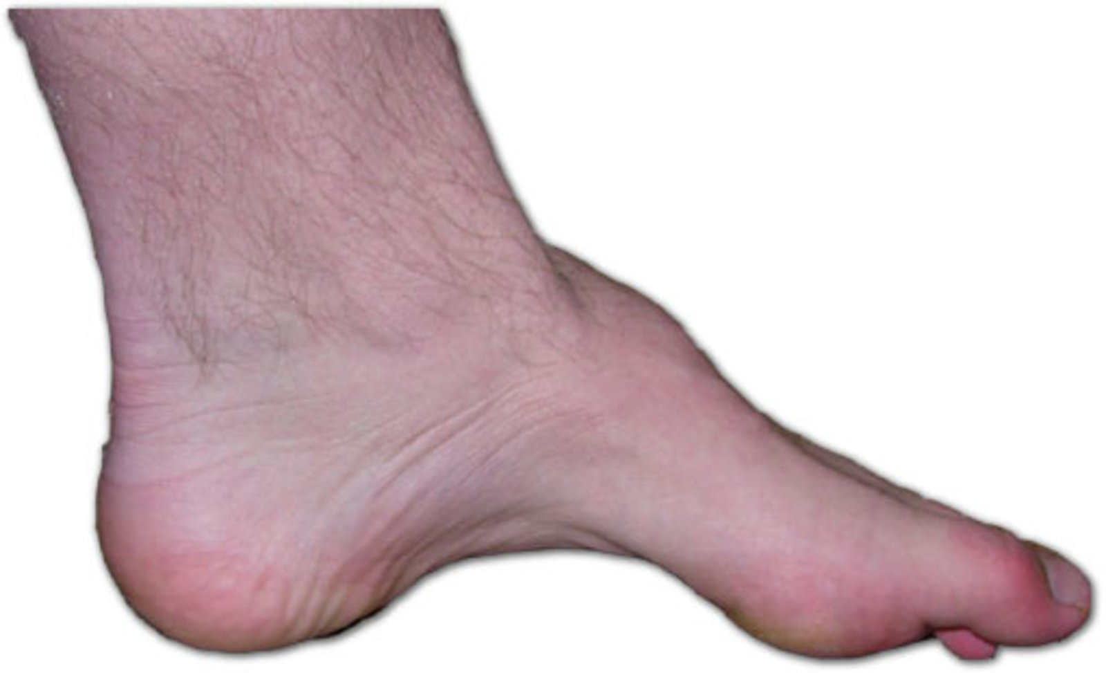 Pes cavus
