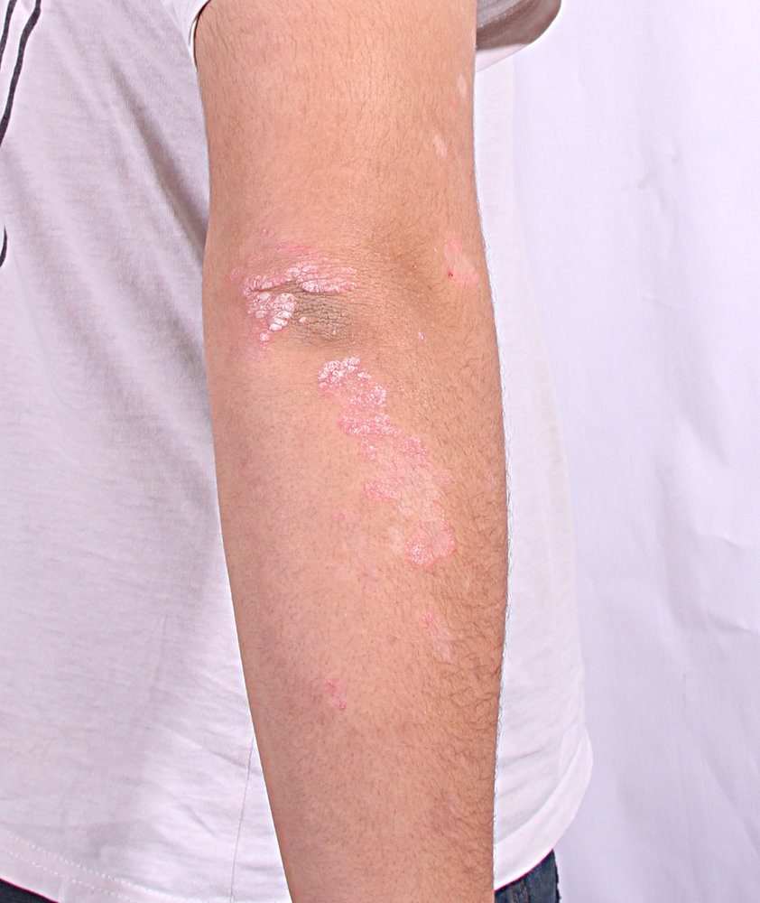 Plaque psoriasis