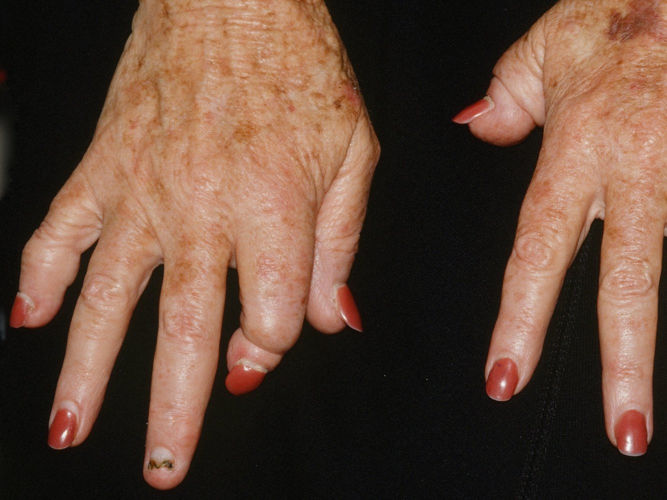 Psoriatic arthritis
