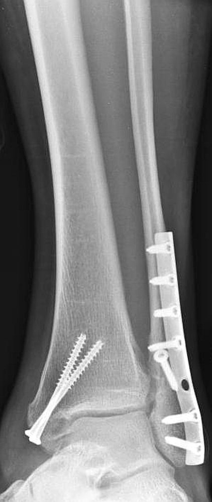 Bimalleolar fracture after open reduction-internal fixation surgery (1/2)