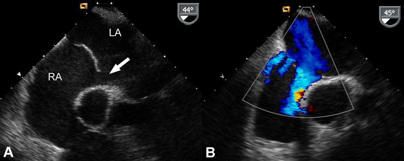 Atrial septal defect