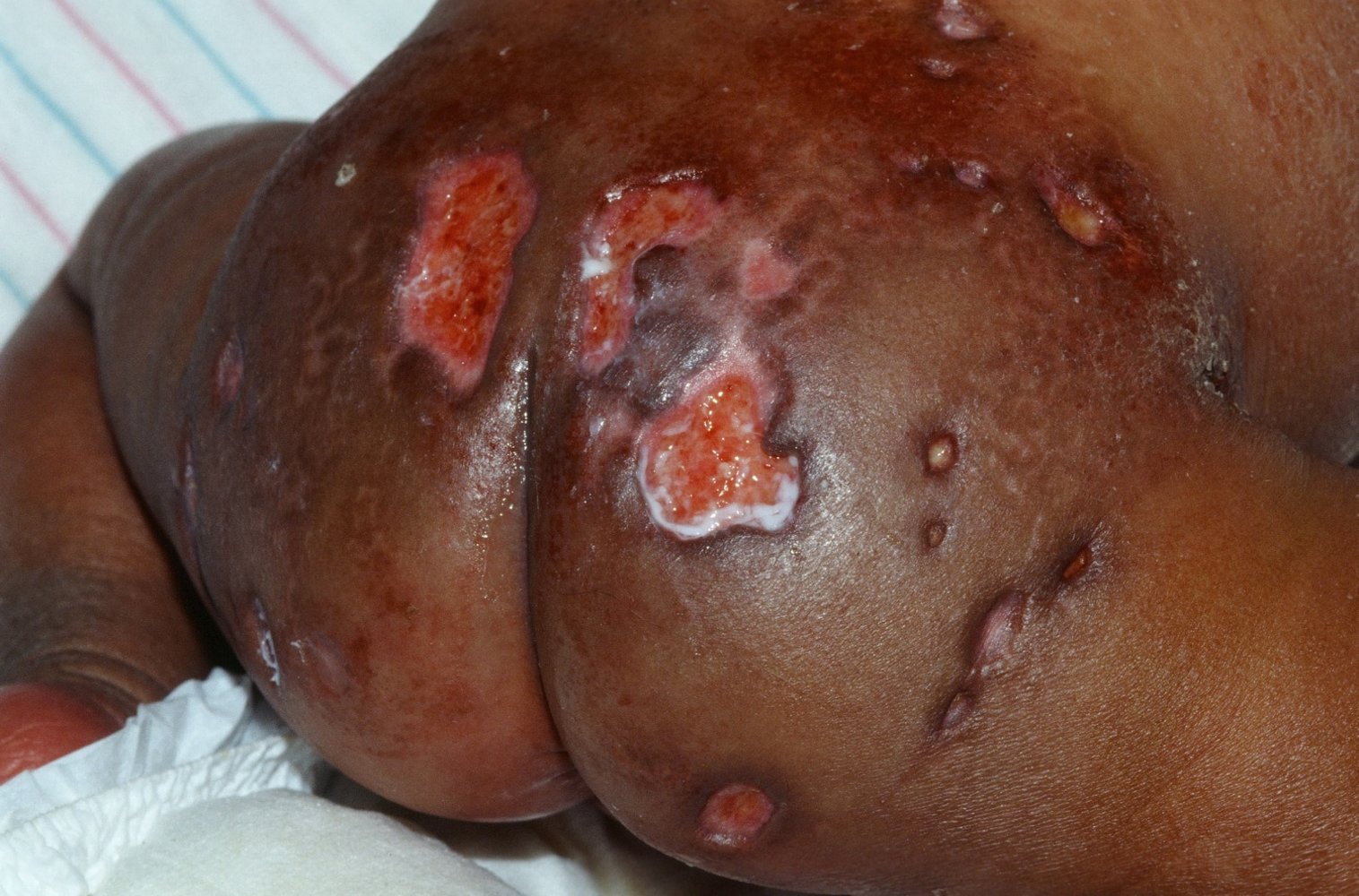 Ecthyma gangrenosum