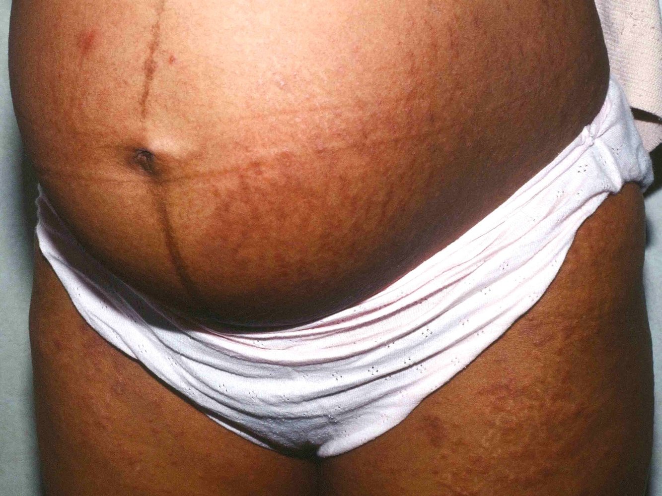 Linea nigra and polymorphic eruption of pregnancy