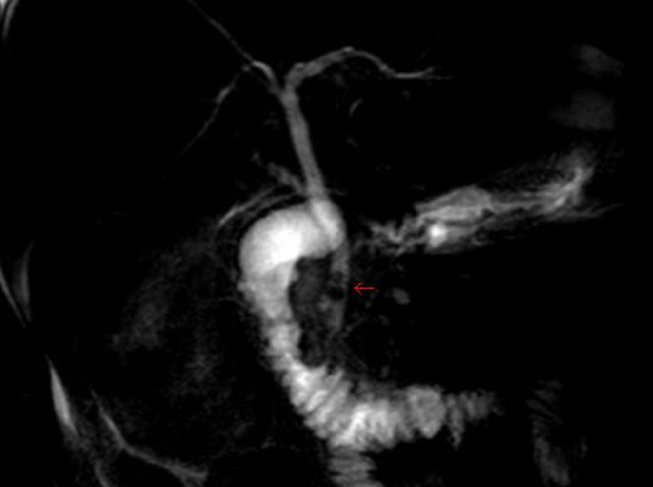 MRCP showing choledocholithiasis