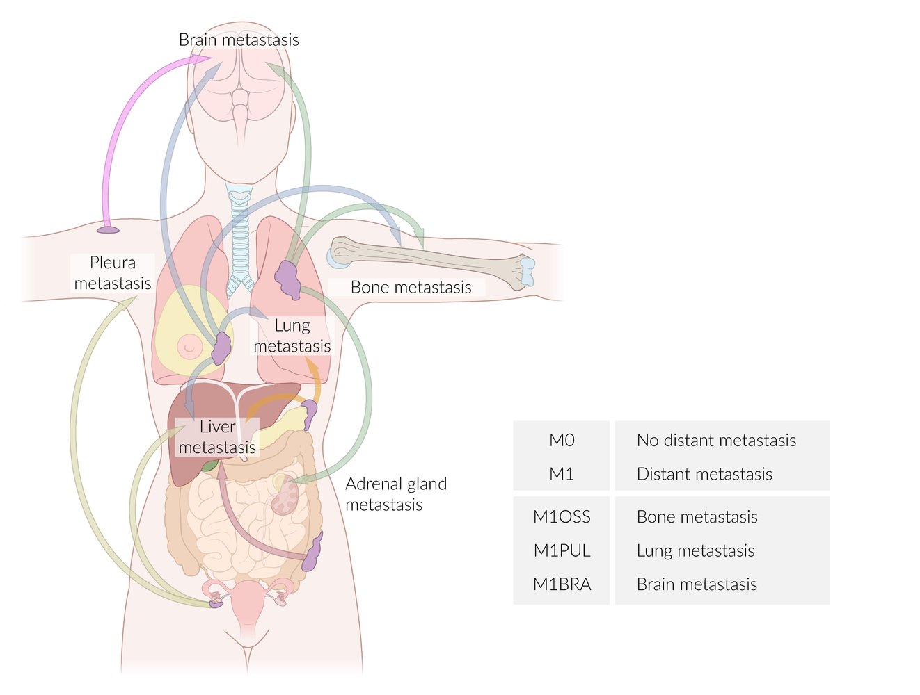 Most common routes of metastasis with TNM classification
