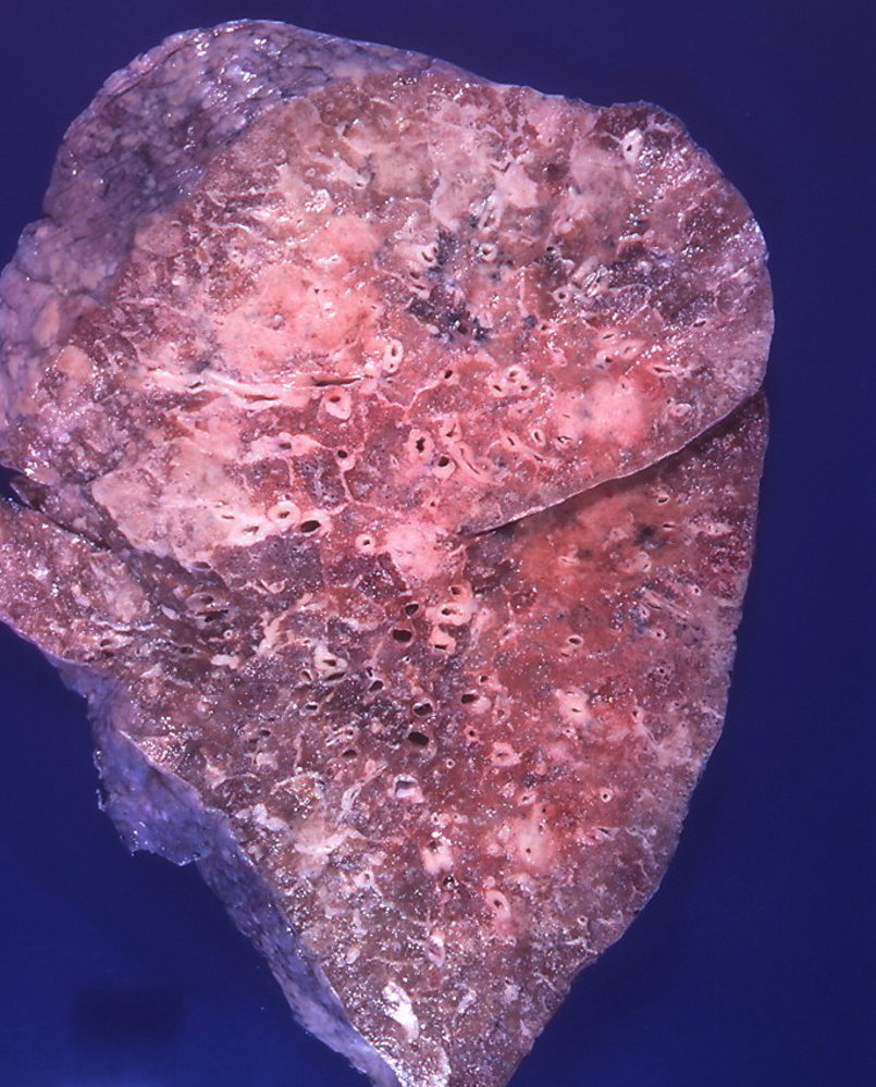 Lung metastases