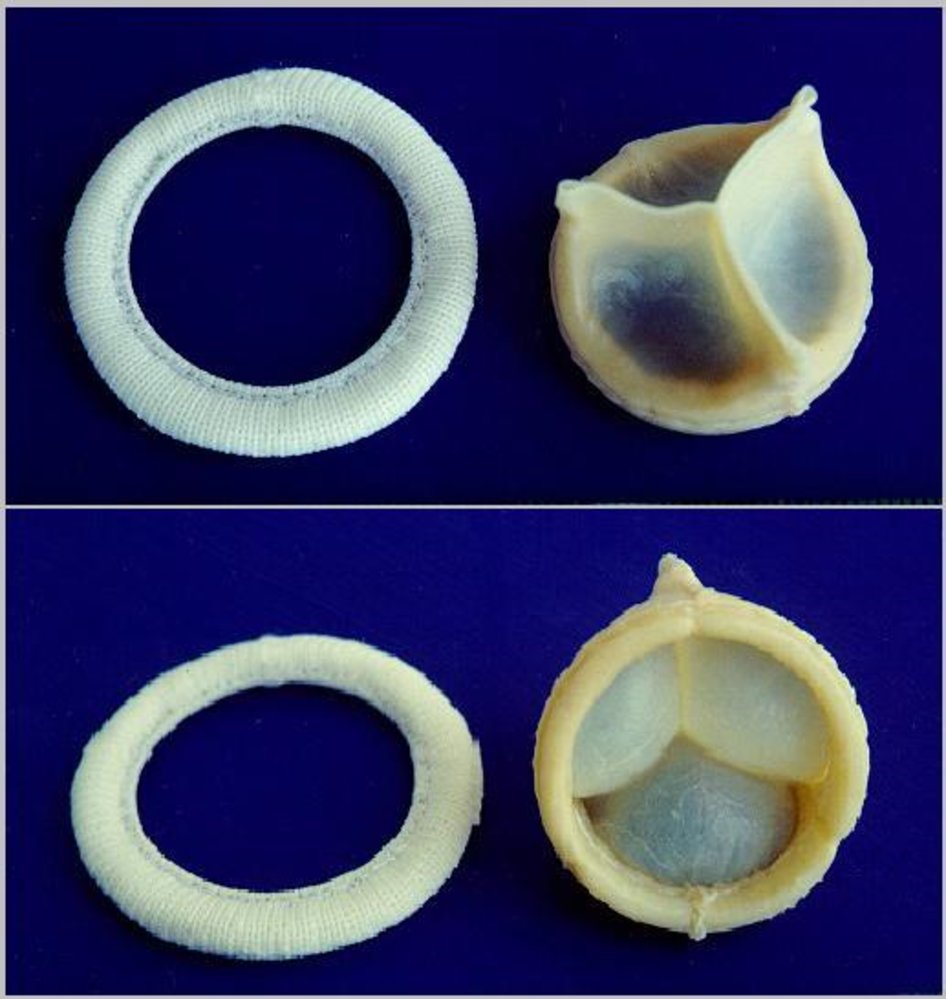 Bioprosthetic heart valve