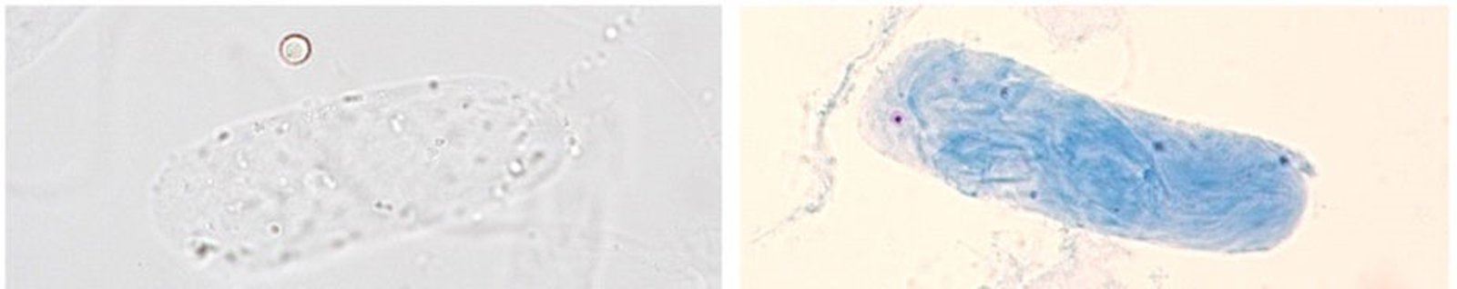 Hyaline cast