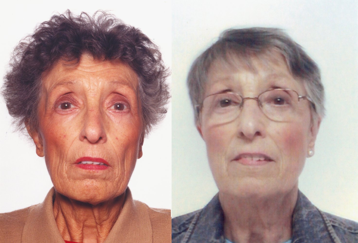 Hyperpigmentation in Addison disease