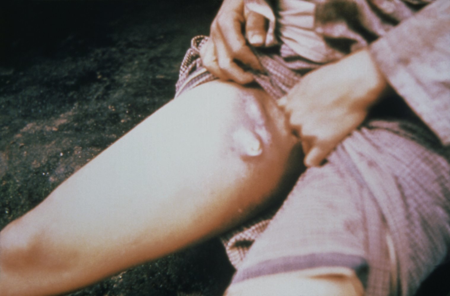 Bubonic plague