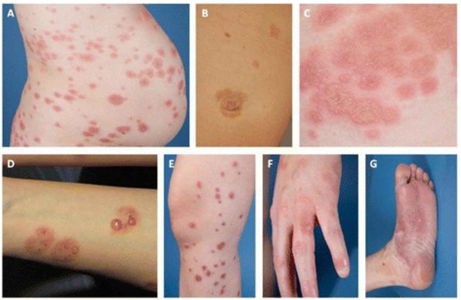 Manifestations of gestational pemphigoid