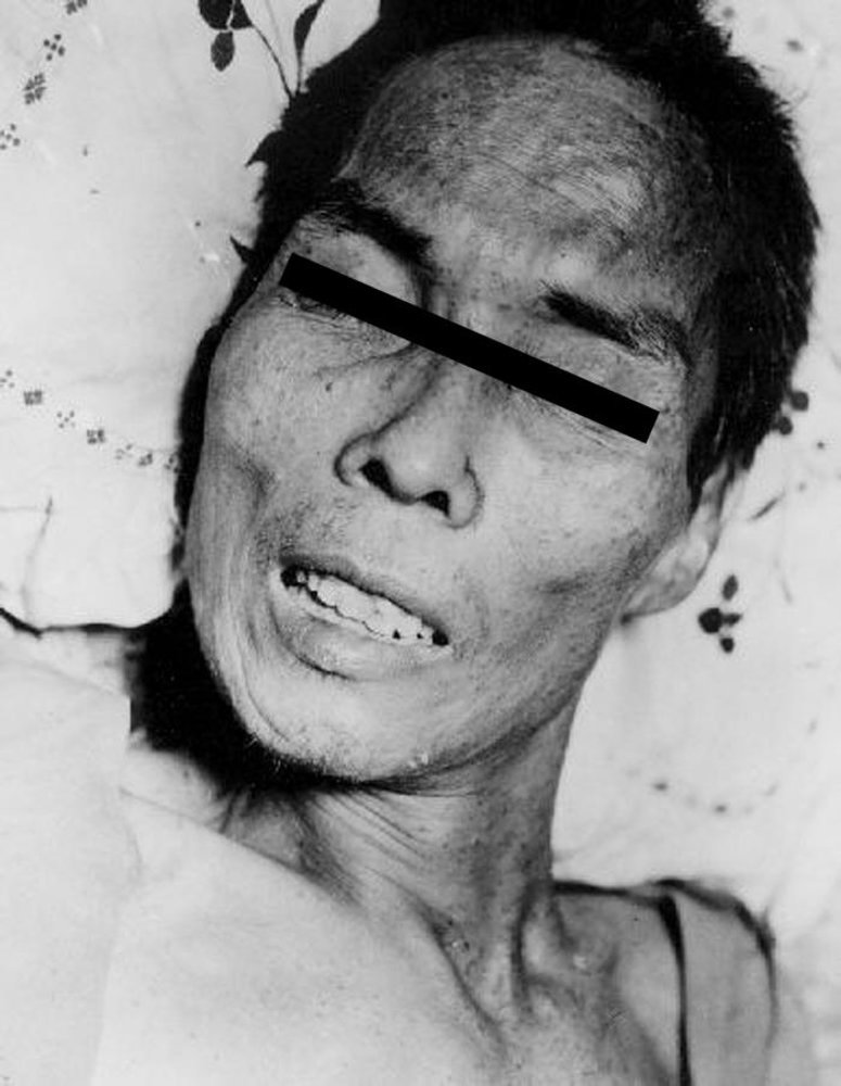 Risus sardonicus ('sardonic laughter') in tetanus