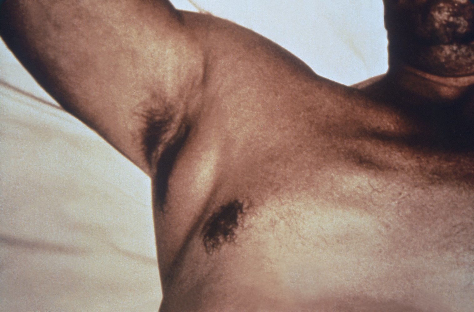 Axillary lymph node swelling due to plague
