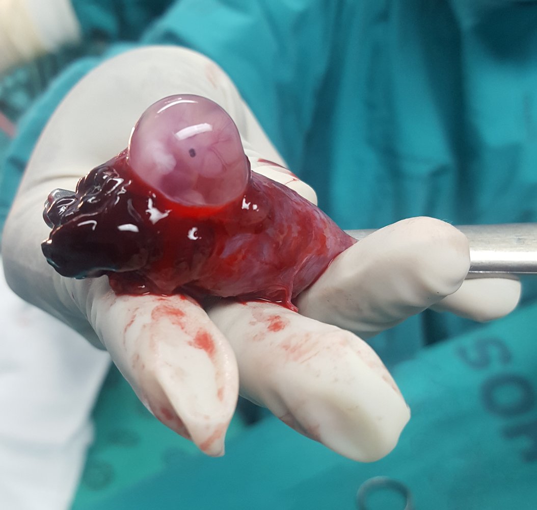 Fallopian tube with an ectopic pregnancy