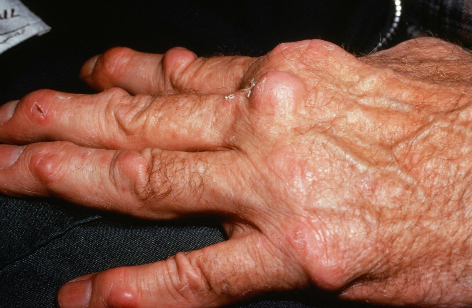 Rheumatoid nodules