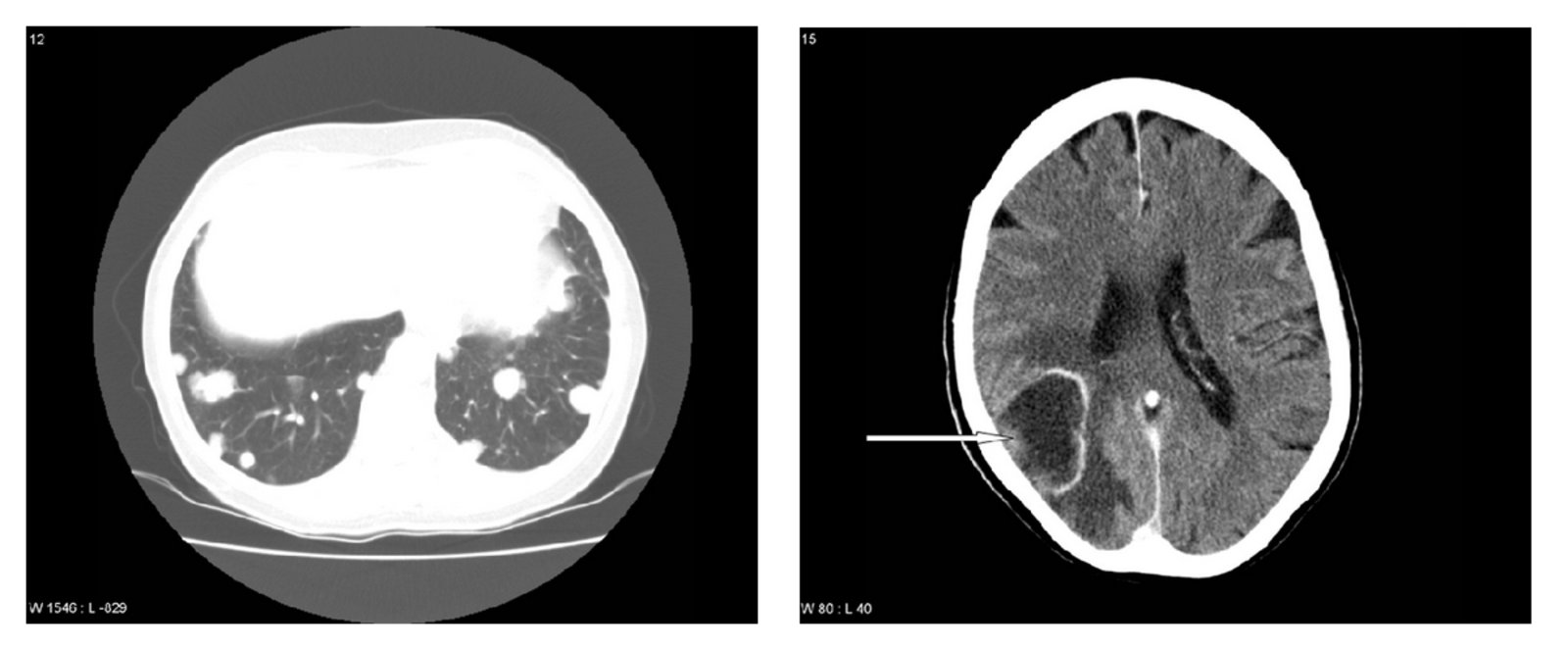 Lung and brain metastases following breast carcinoma