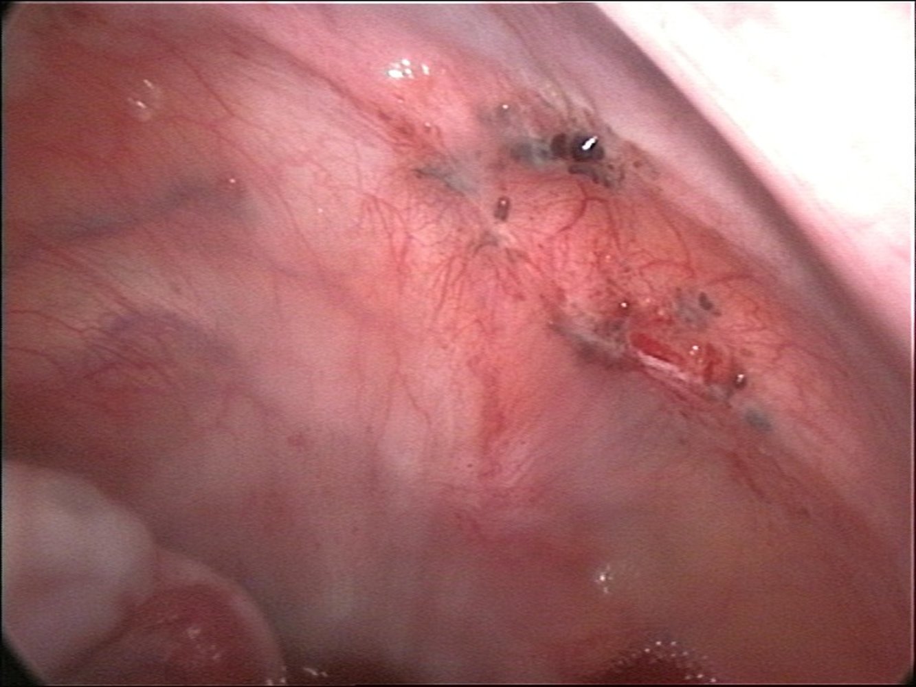 Peritoneal endometriosis