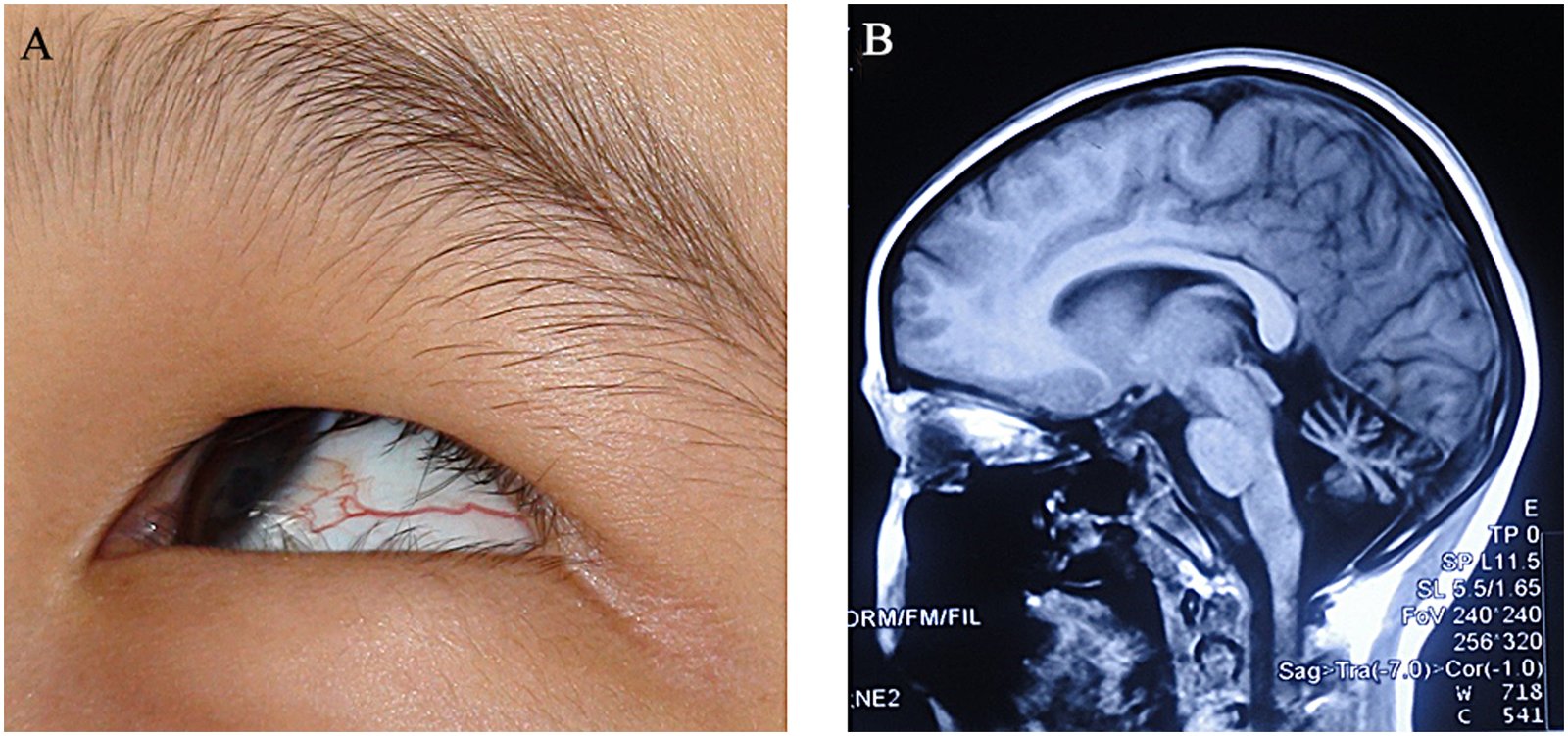Ocular and cerebral manifestations in ataxia teleangiectasia