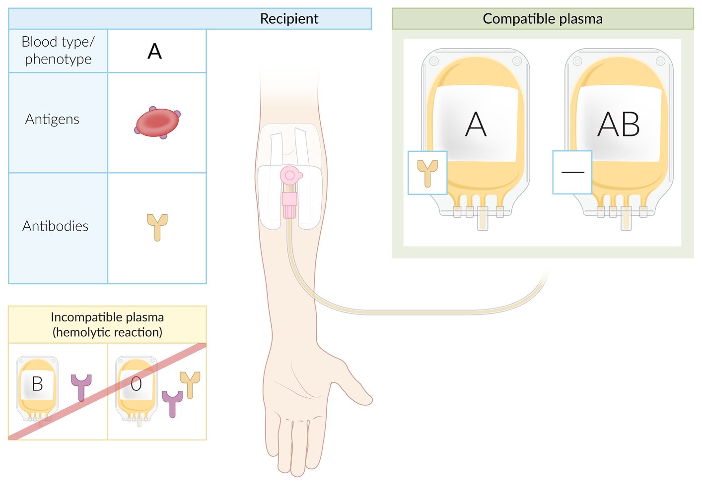 Blood type A plasma transfusion compatibility