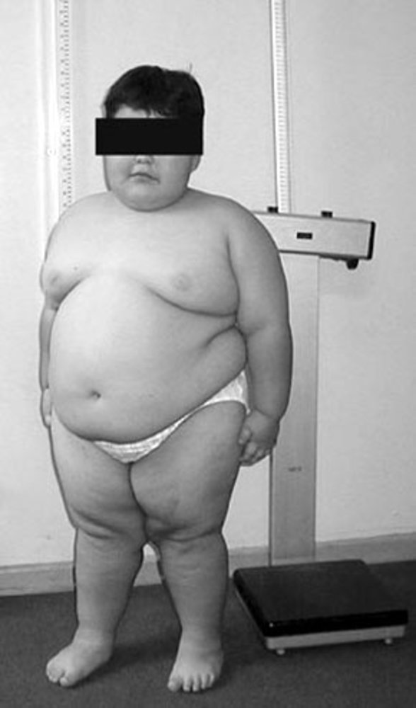Child with Prader-Willi syndrome