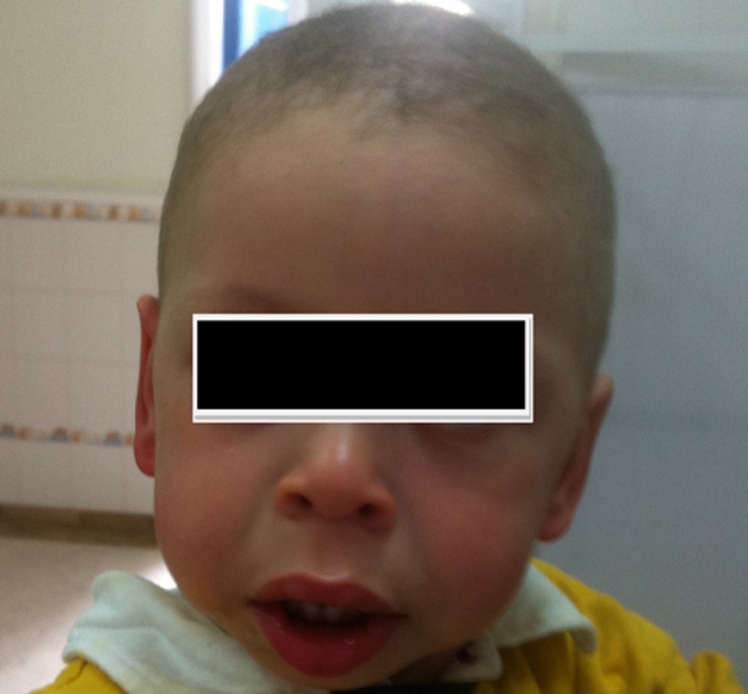 Williams syndrome