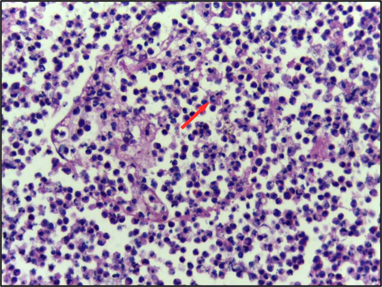 Pneumonia