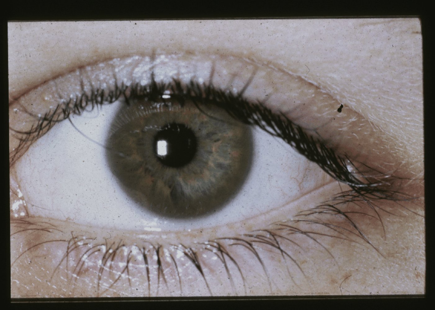 Kayser-Fleischer ring