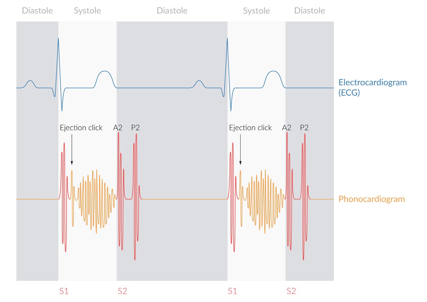 Heart murmur in pulmonary stenosis