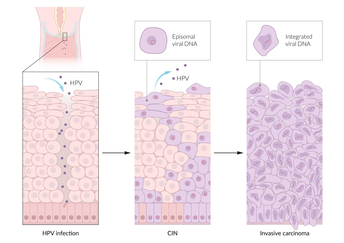 Pathophysiology of the development of cervical cancer