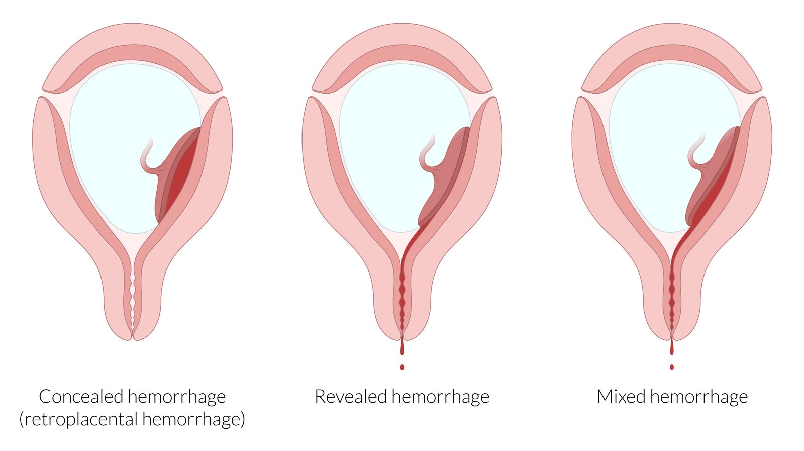 Types of hemorrhage in placental abruption