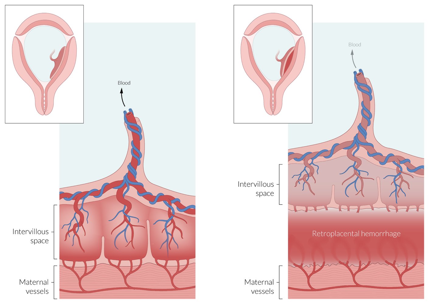 Placental abruption prior to delivery