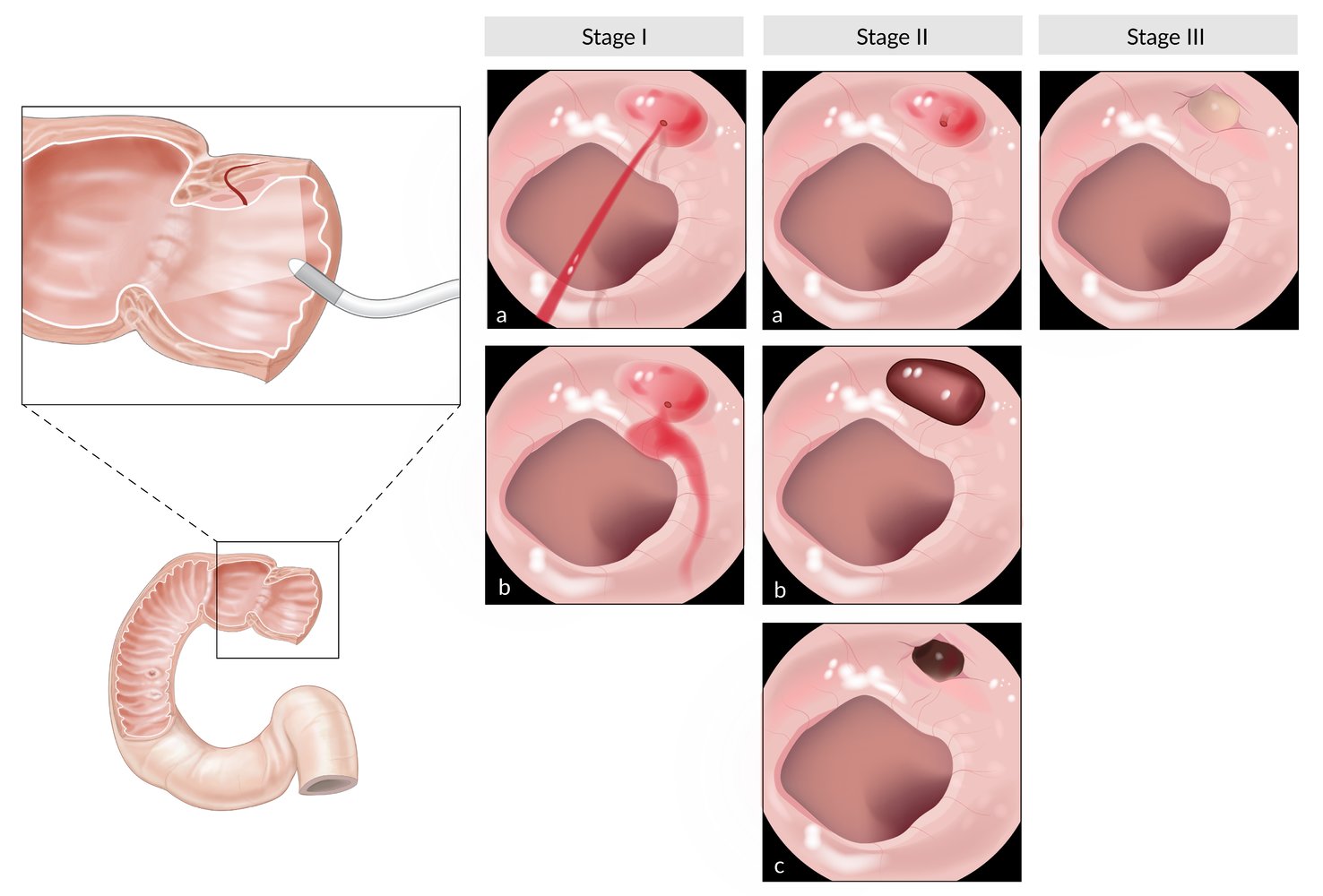 Forrest classification of upper gastrointestinal hemorrhages