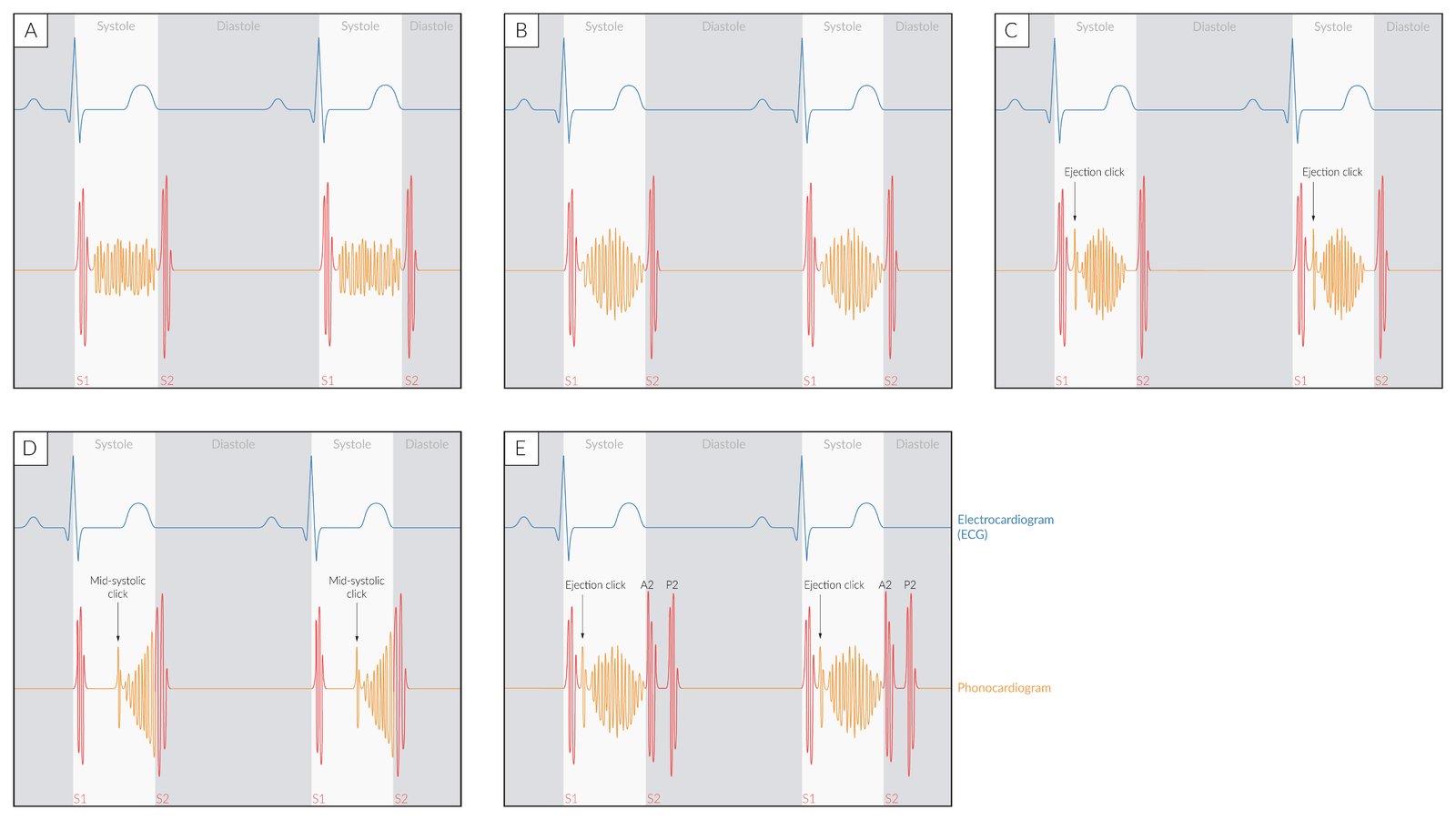 Phonocardiogram of systolic heart murmurs