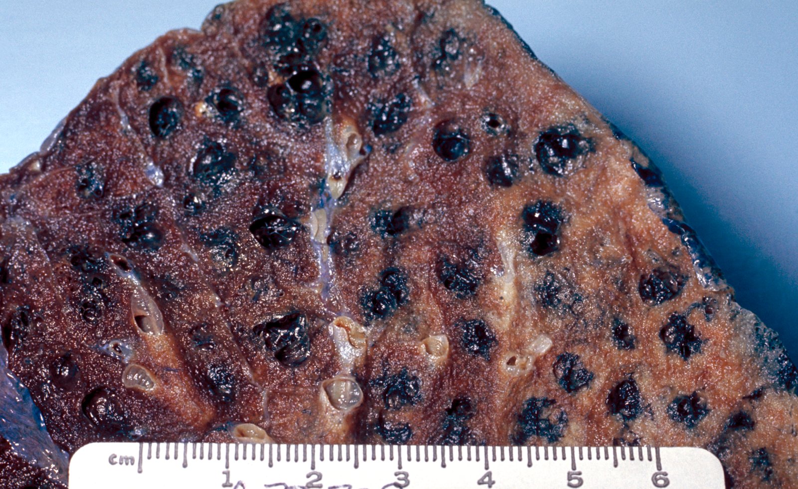 Centrilobular pulmonary emphysema