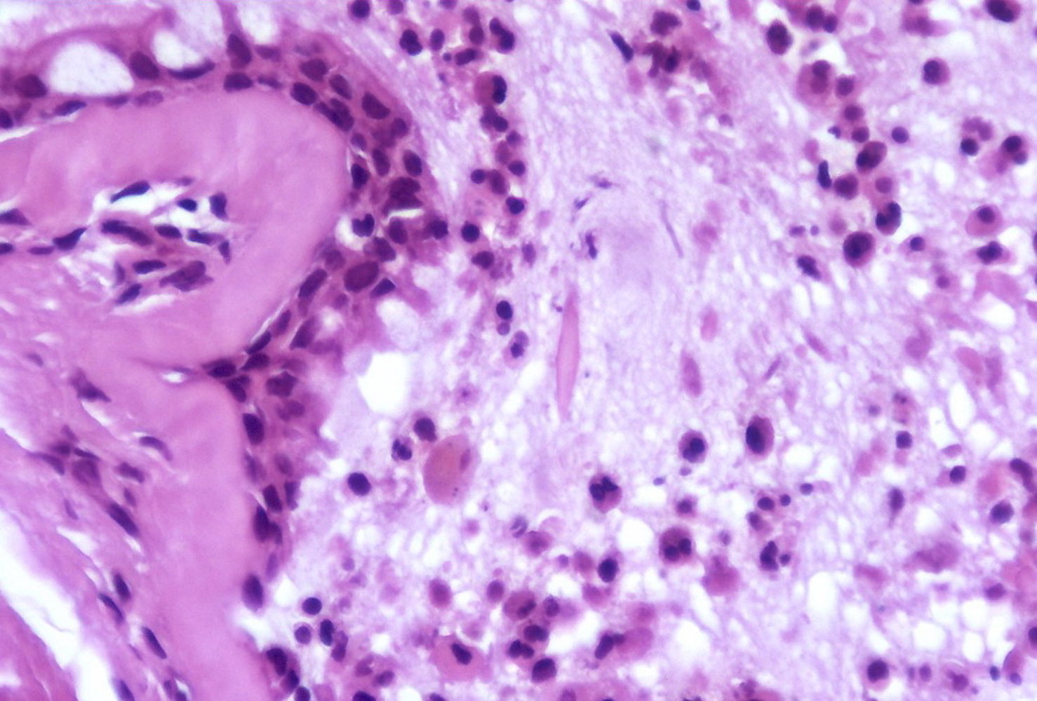 Charcot-Leyden crystal