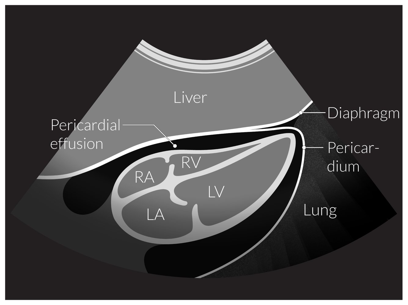 Pericardial effusion