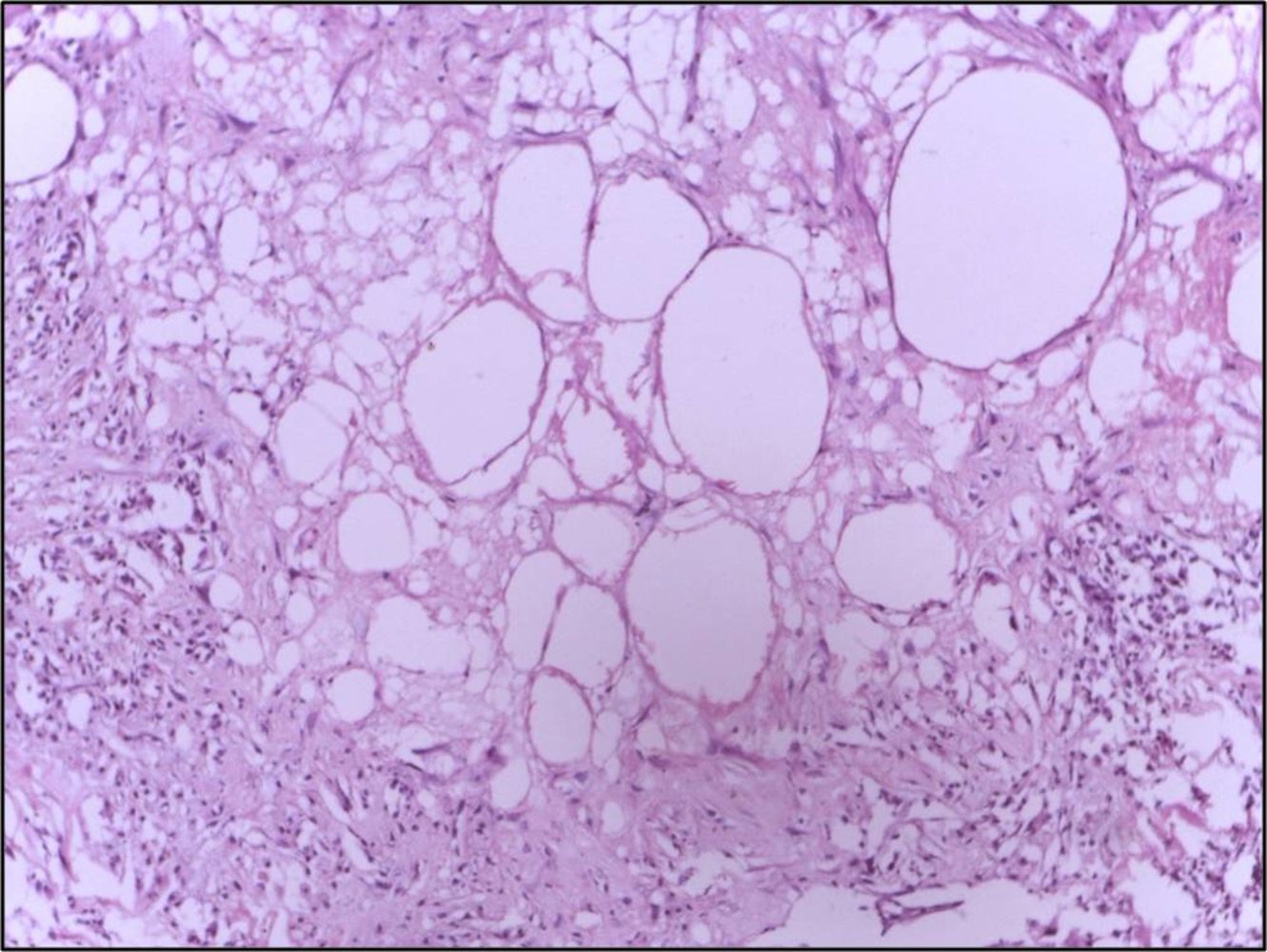 Breast fat necrosis