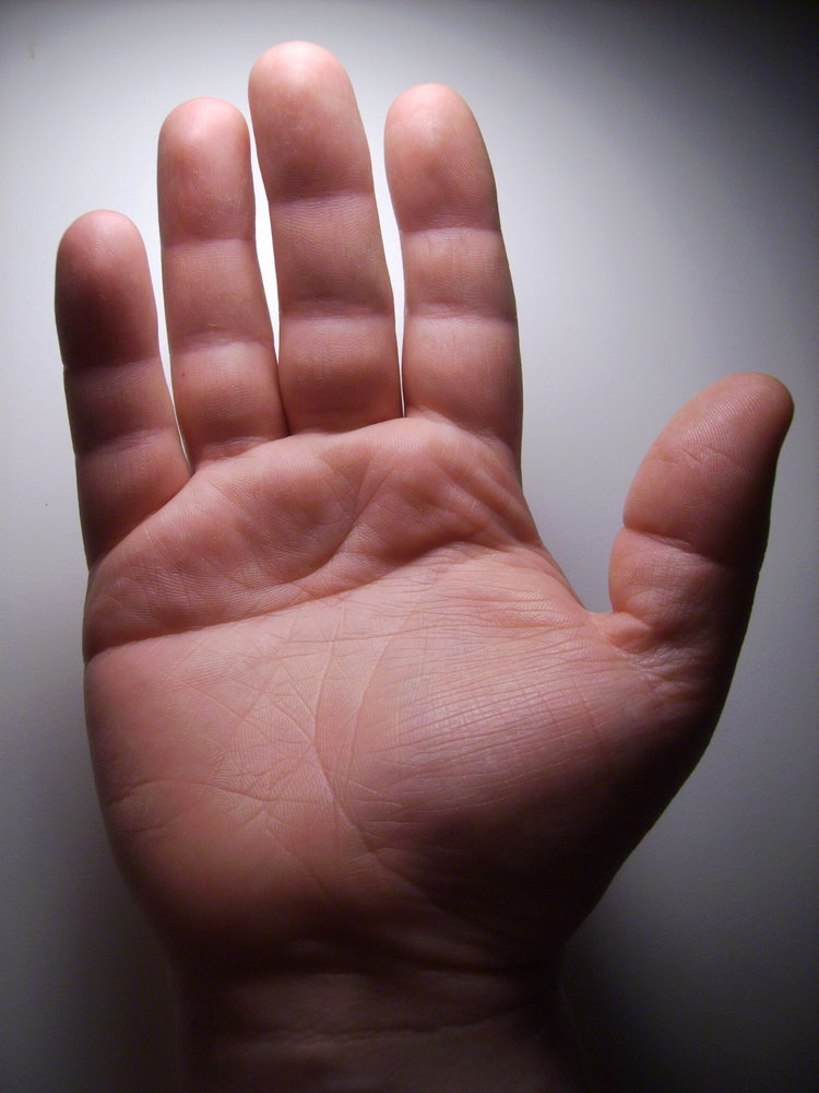 Single transverse palmar crease