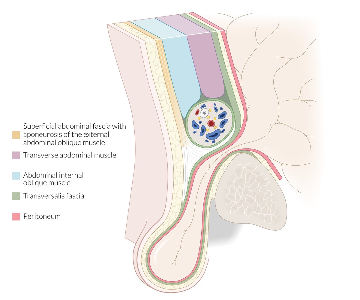 Femoral hernia