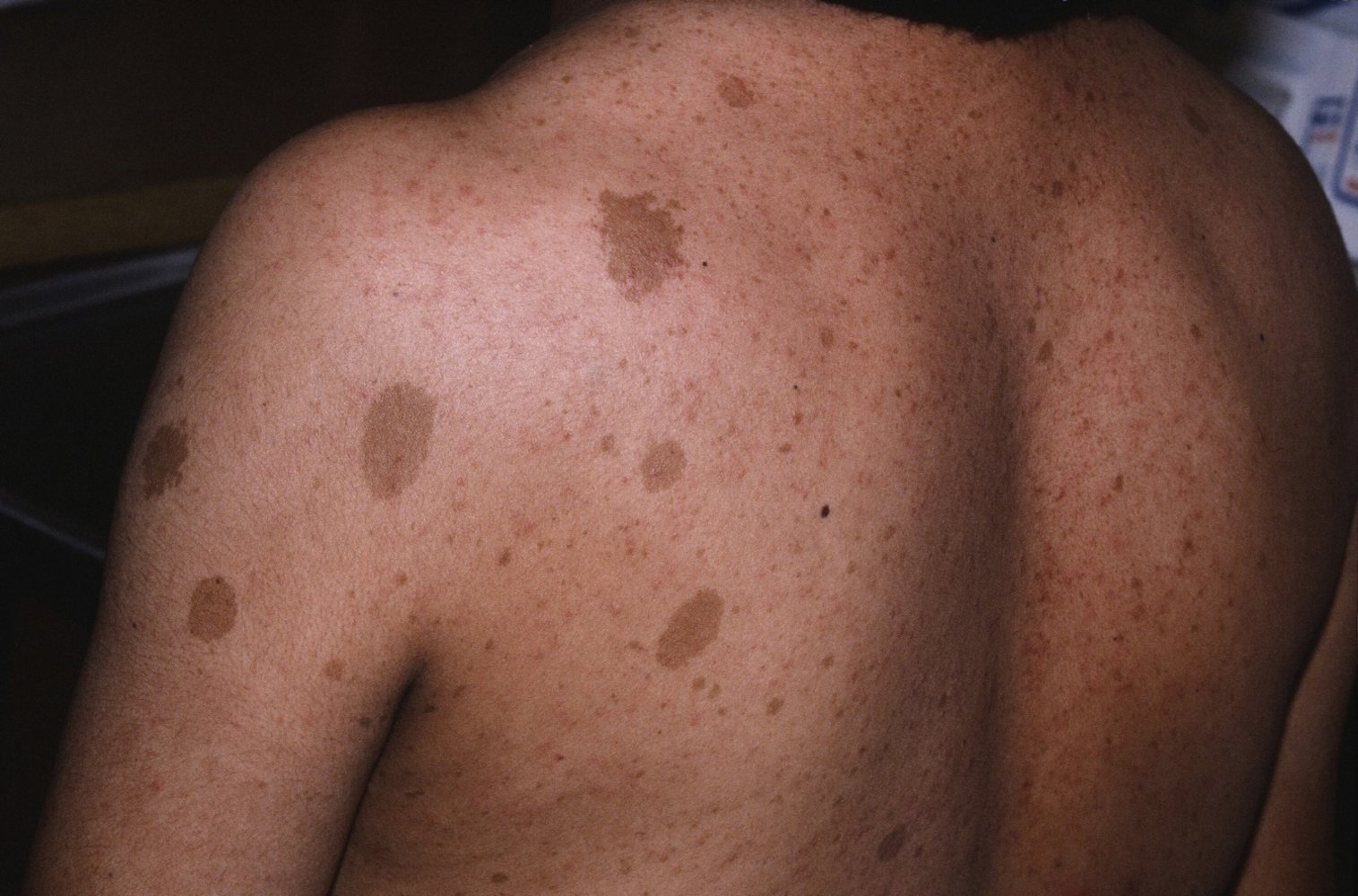 Neurofibromatosis type 1