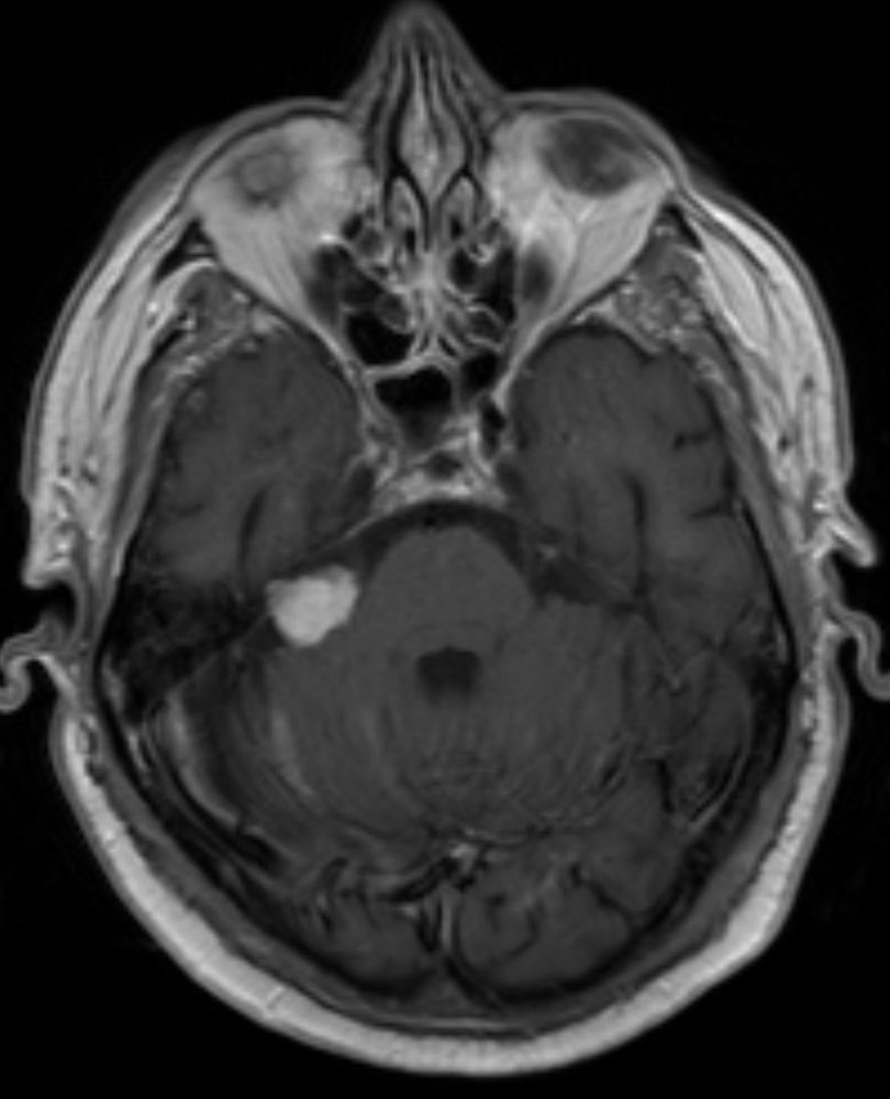 Acoustic neuroma