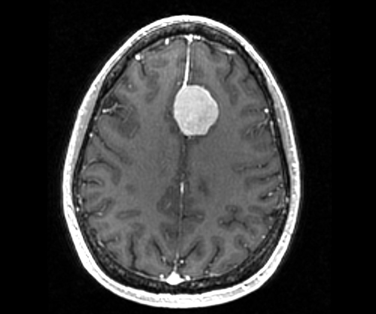 Meningioma